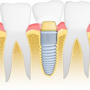 Dental implants.jpg