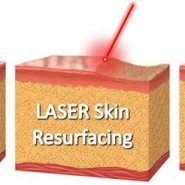 Laser dermabrasion treatment at Dischem Salon
