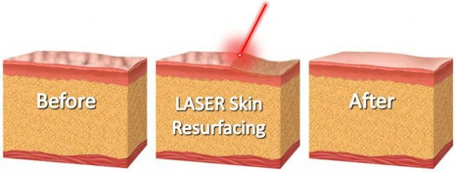 Laser dermabrasion treatment at Dischem Salon